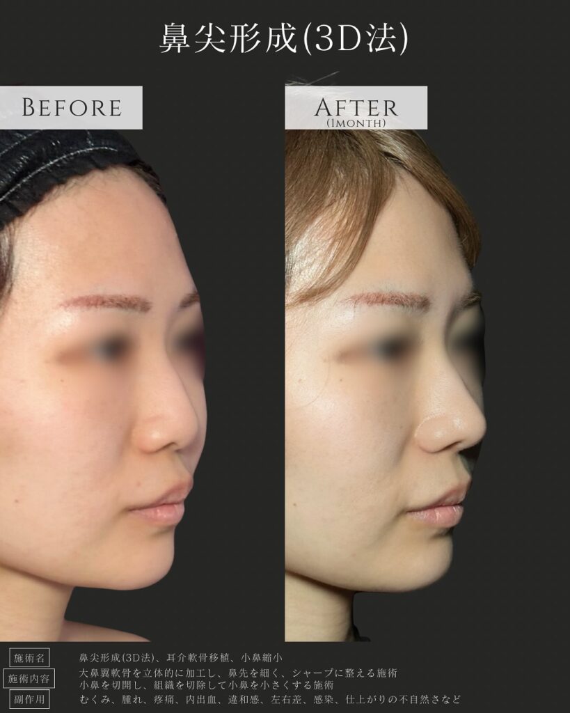 鼻尖形成と耳介軟骨い移植と小鼻縮小の症例写真 (1)