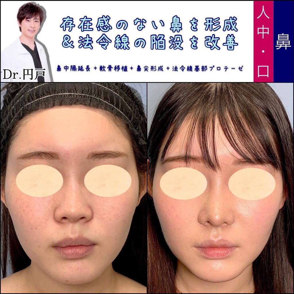 鼻中隔延長と軟骨移植お鼻尖形成と貴族手術の症例写真 (2)