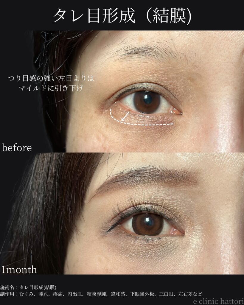 タレ目形成の症例写真 (26)