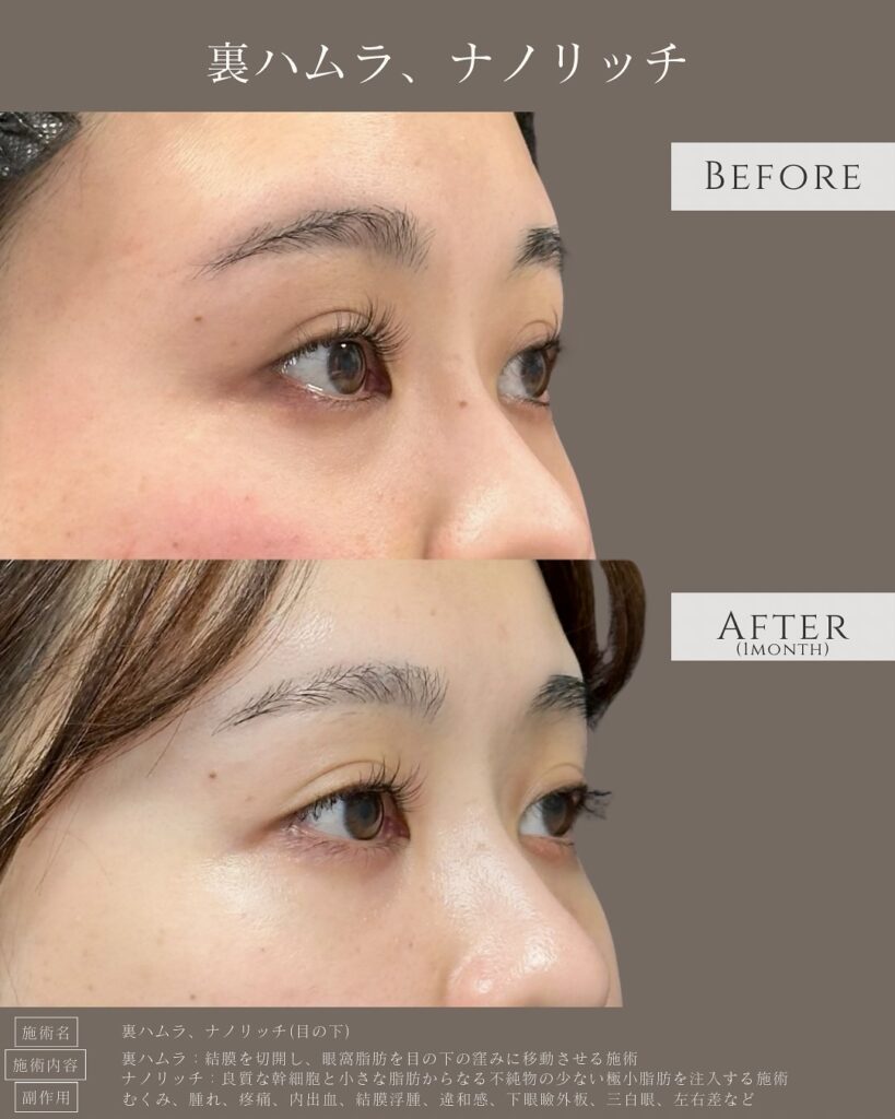 裏ハムラ法とナノリッチの症例写真 (10)