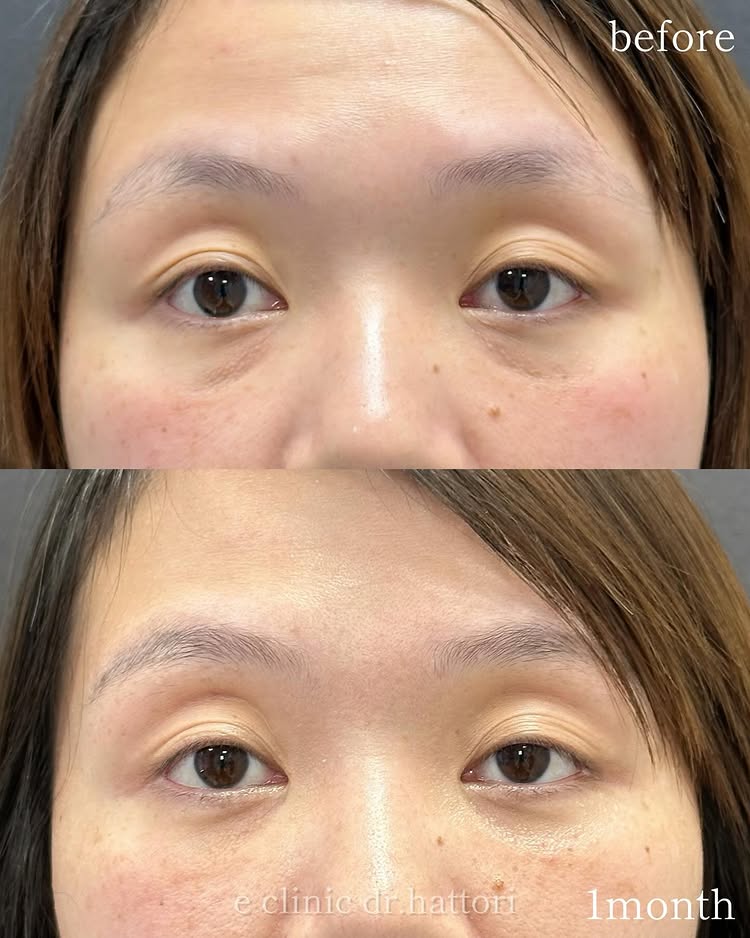 裏ハムラ法の症例写真 (70)