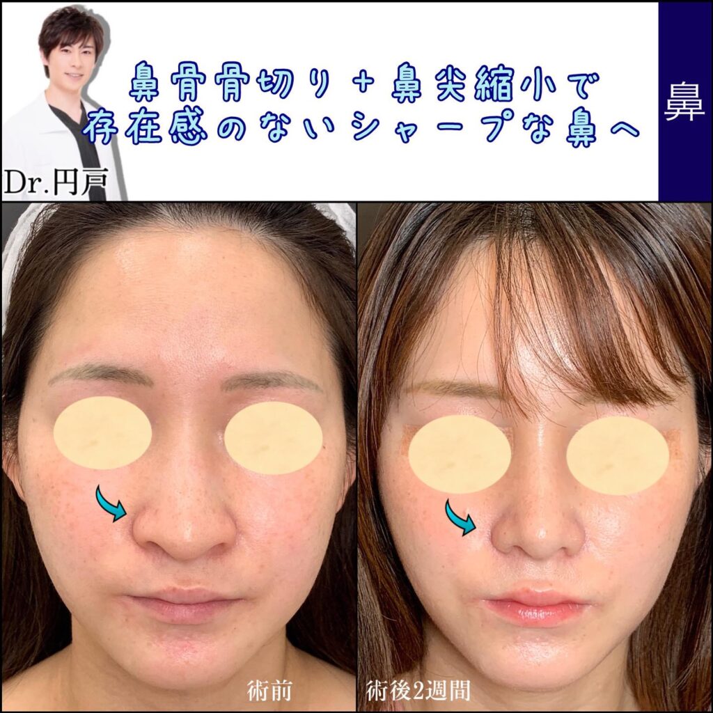 鼻骨骨切りと鼻尖形成の症例写真 (1)