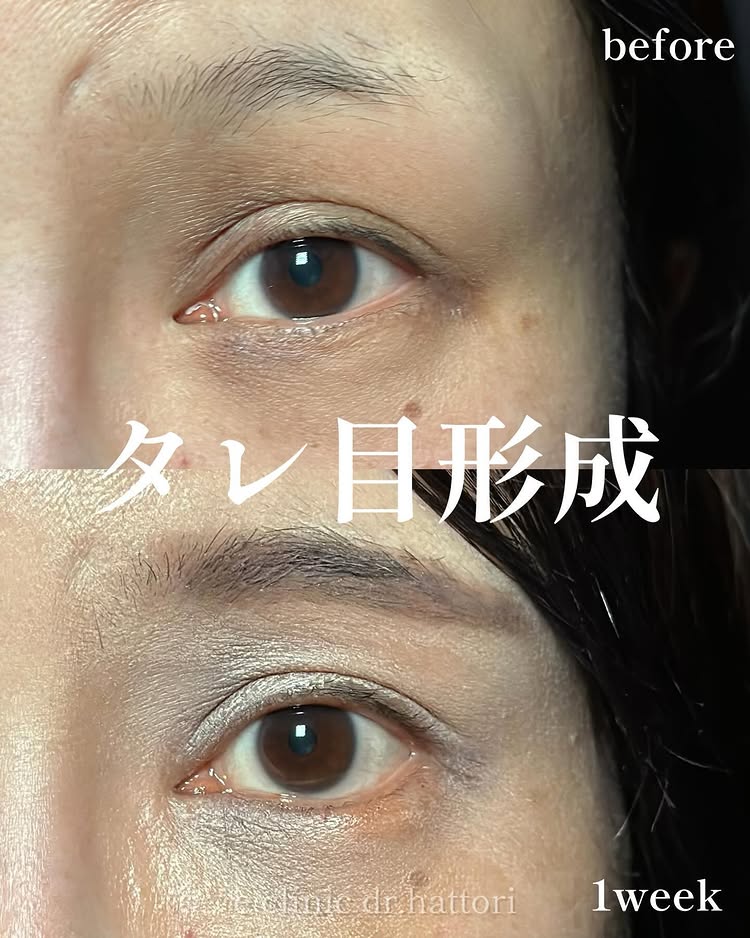 タレ目形成の症例写真 (29)