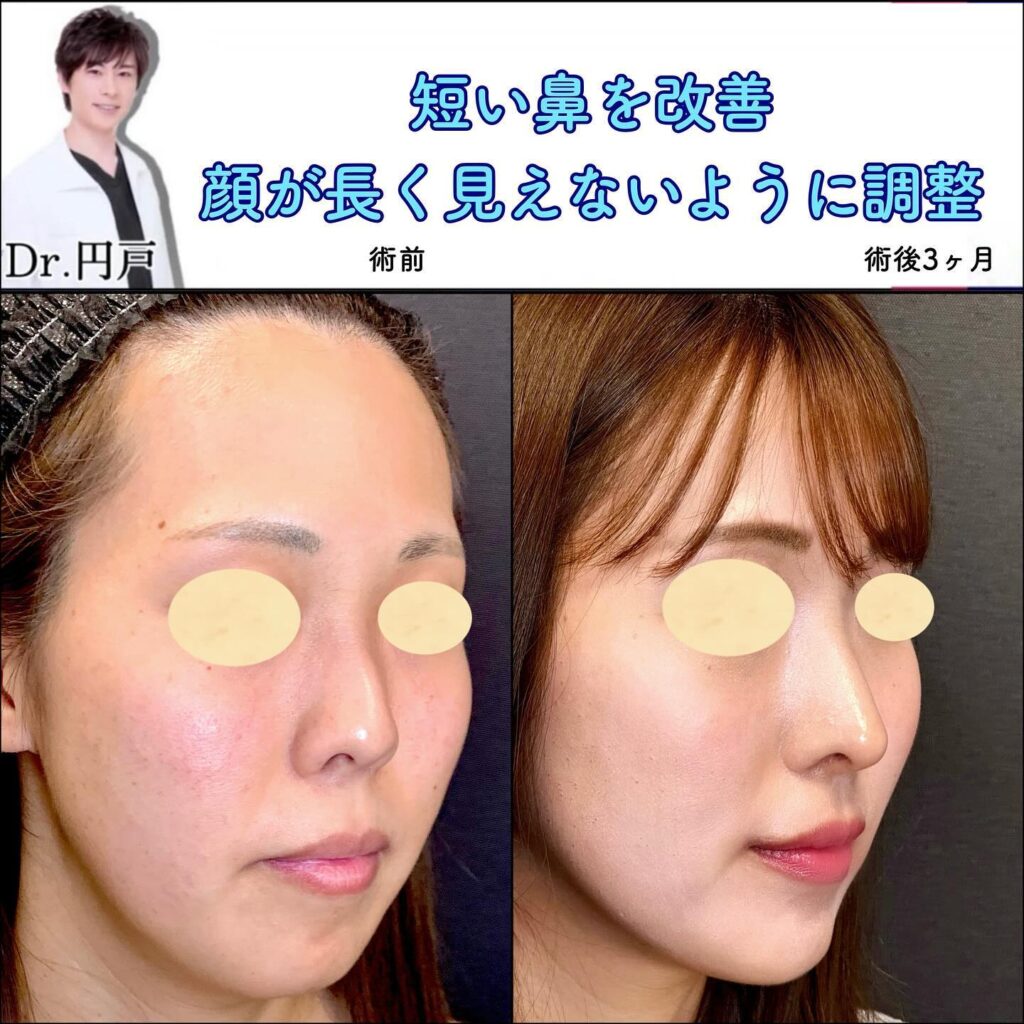 鼻尖形成と軟骨移植と鼻中隔延長と口角挙上と顎のヒアルロン酸の症例 (2)