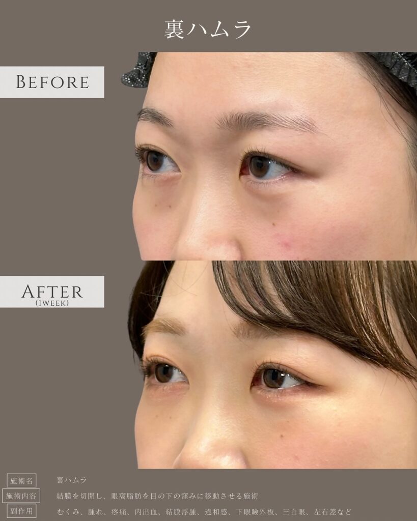 裏ハムラ法の症例写真 (35)