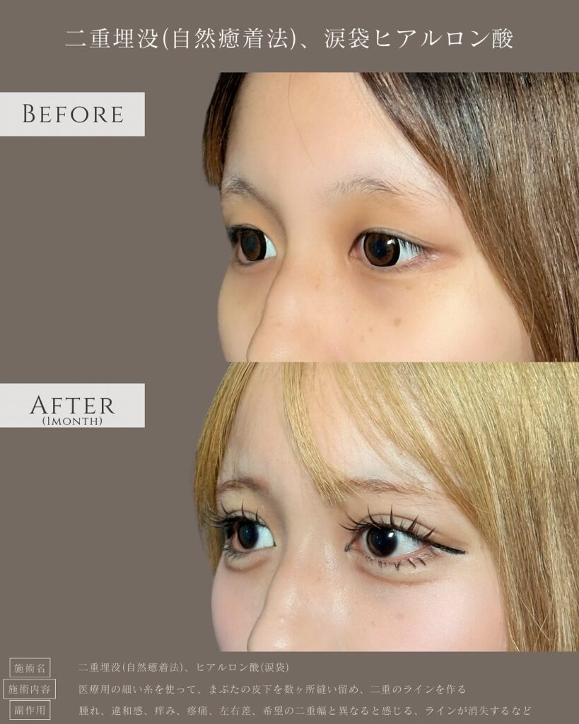 自然癒着法と涙袋のヒアルロン酸の症例写真 (7)