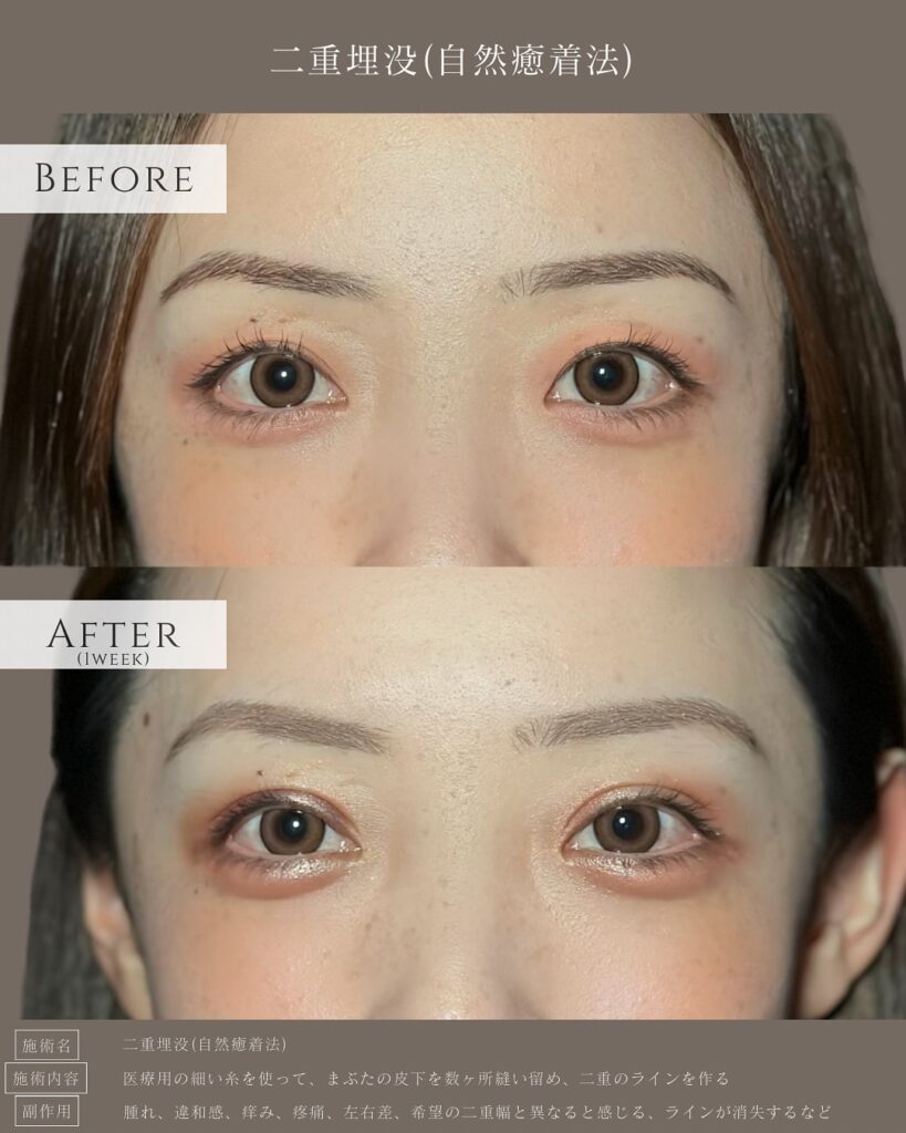 自然癒着法の症例写真 (5)