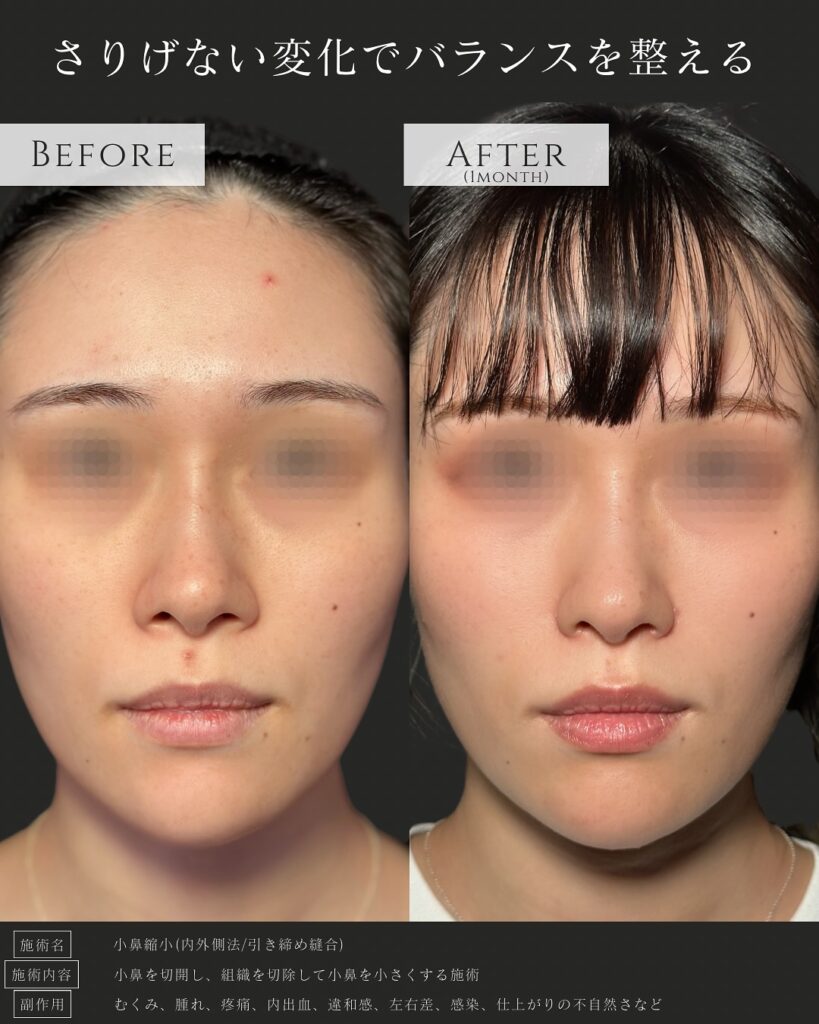 小鼻縮小の症例写真 (3)