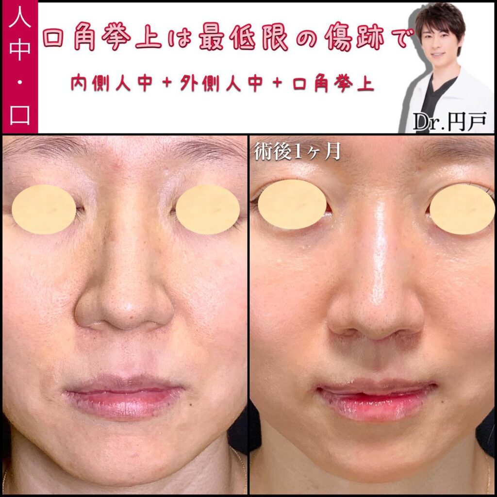 口角挙上と外側人中短縮と内側人中短縮を同時に行った症例