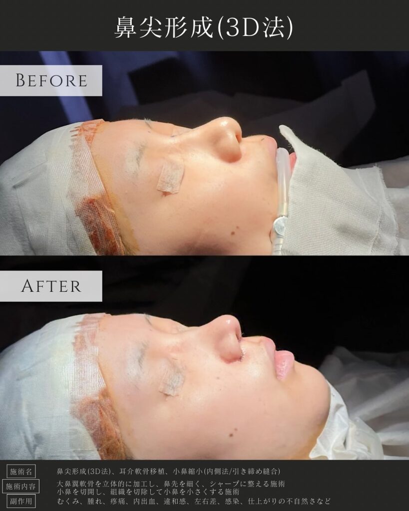 鼻尖形成と耳介軟骨移植と小鼻縮小の症例写真 (7)