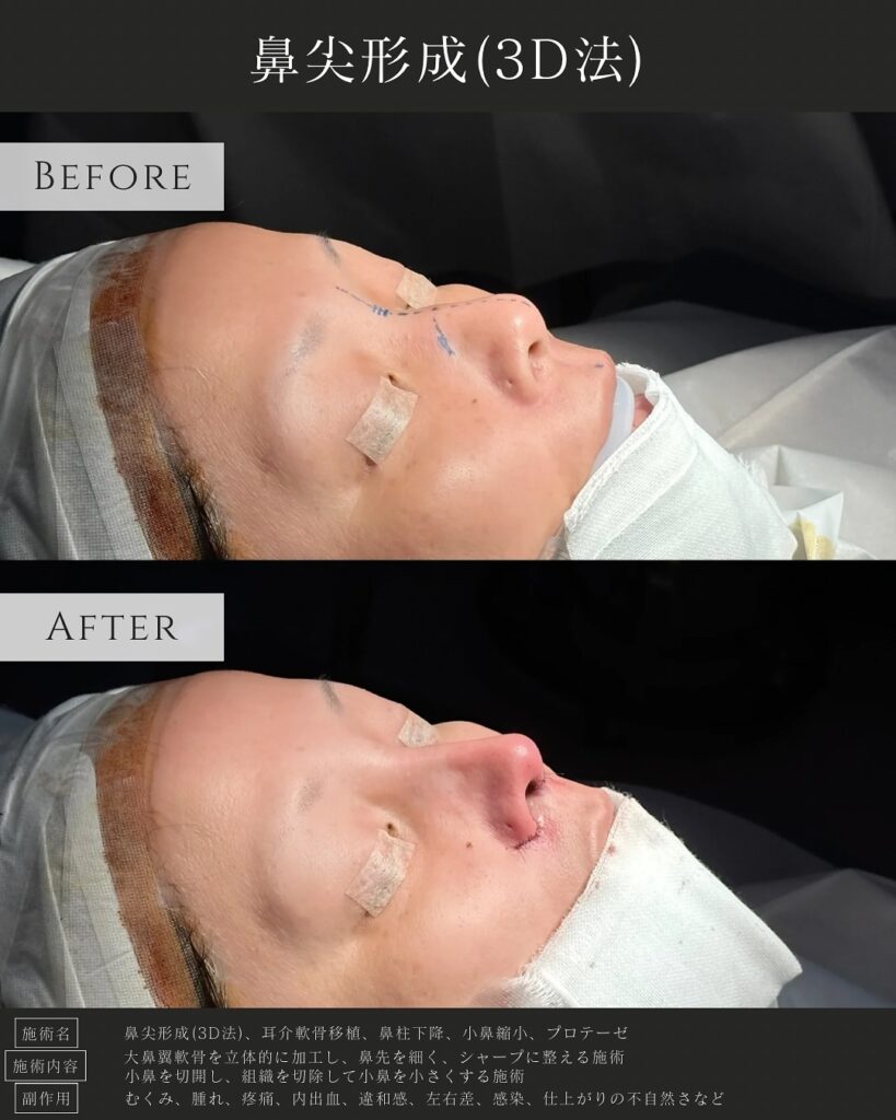鼻尖形成と耳介軟骨移植と小鼻縮小とプロテーゼと鼻柱下降の症例写真 (1)