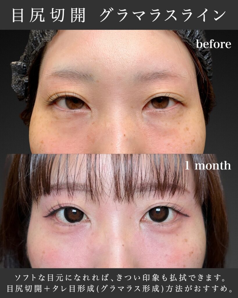 目尻切開とグラマラスライン形成の症例写真