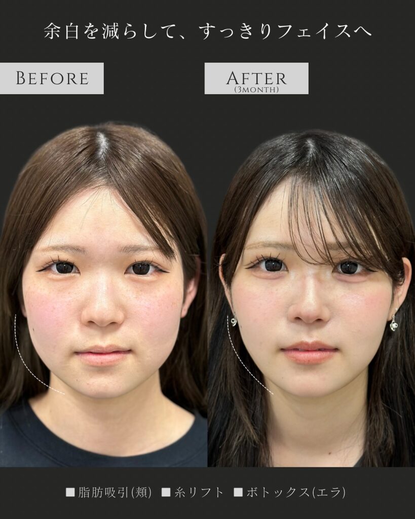 頬の脂肪吸引と糸リフトとエラボトックスの症例写真 (2)