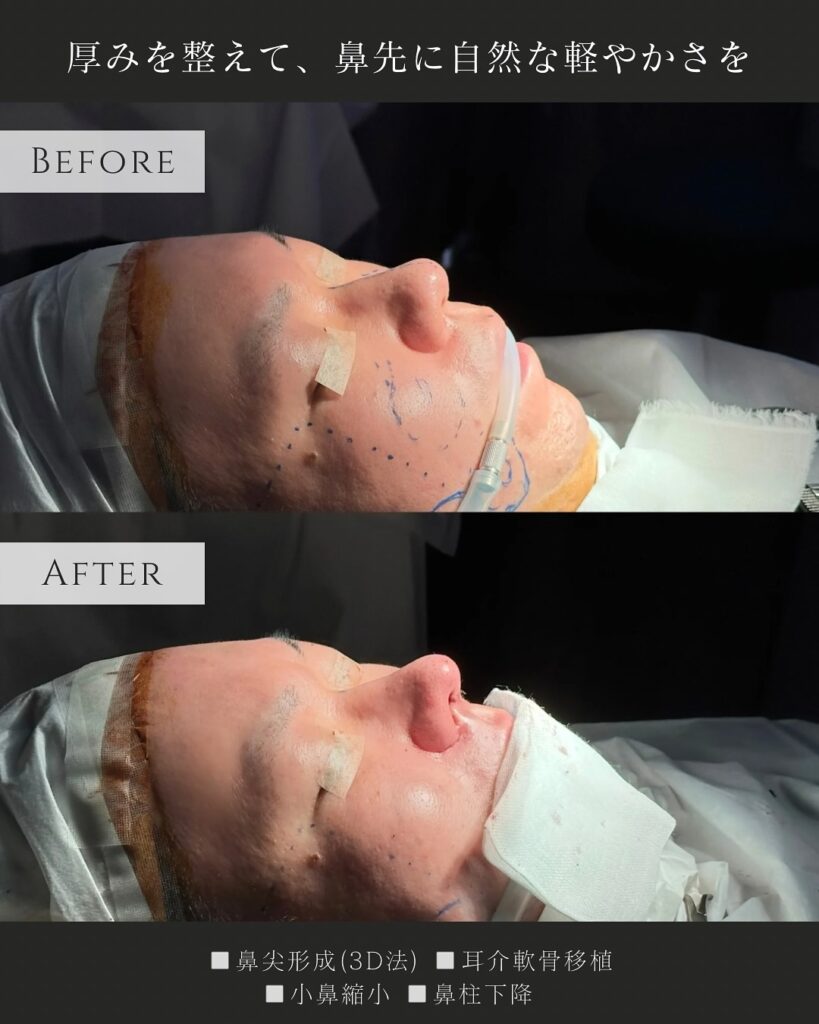 鼻尖形成と耳介軟骨移植と小鼻縮小と鼻柱下降の症例写真 (2)