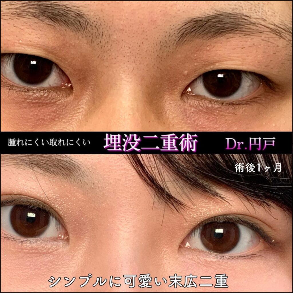 埋没法の症例写真 (12)