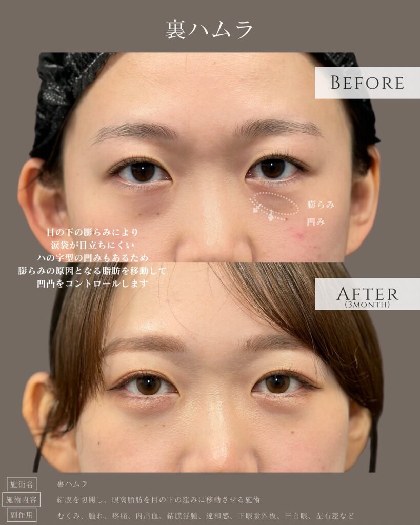 裏ハムラ法の症例写真 (3)