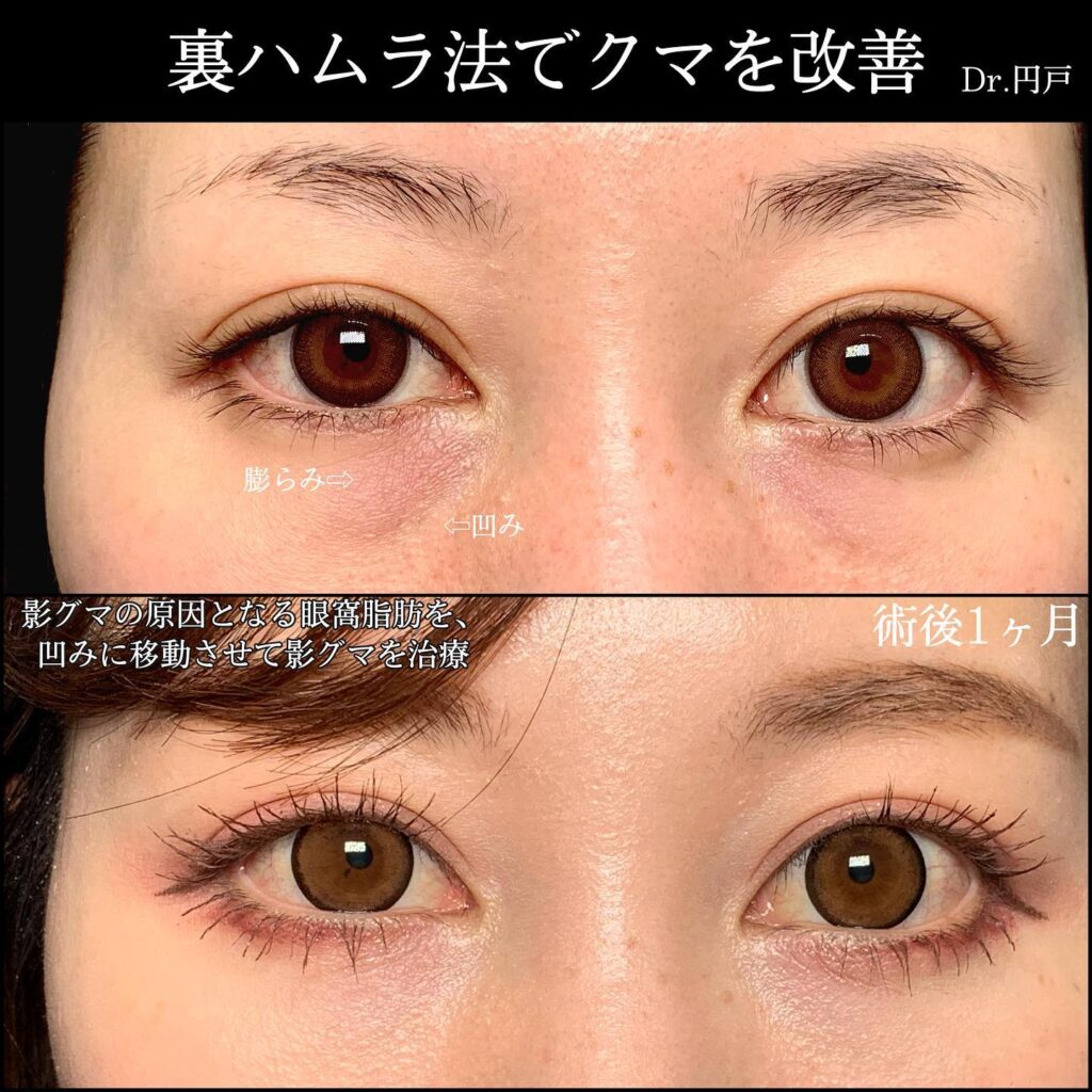 裏ハムラ法の症例写真 (3)