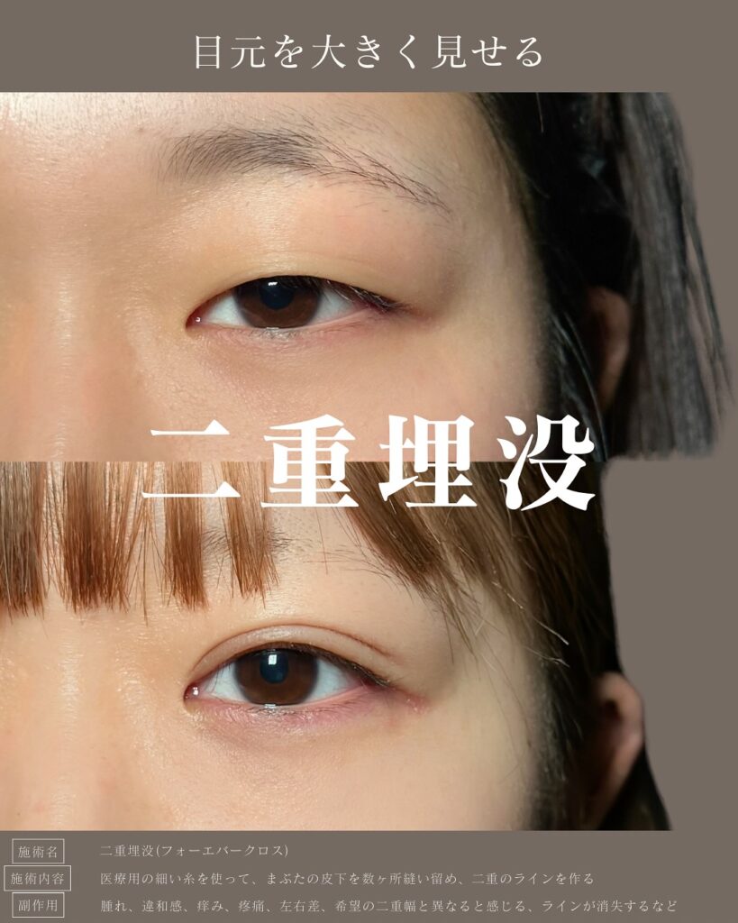 埋没法の症例写真 (8)