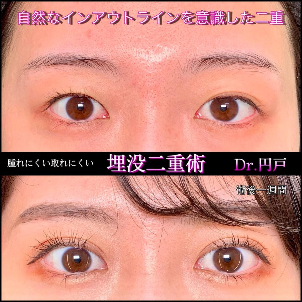 埋没法の症例写真 (8)