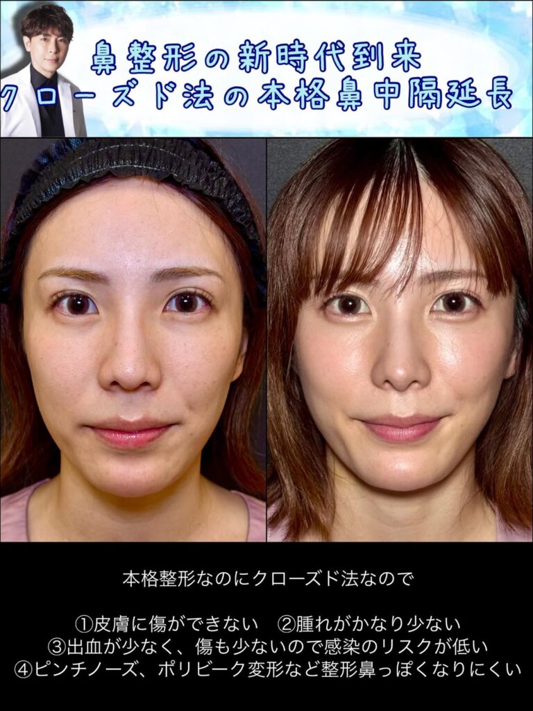 クローズド法の鼻中隔延長の症例動画 (2)