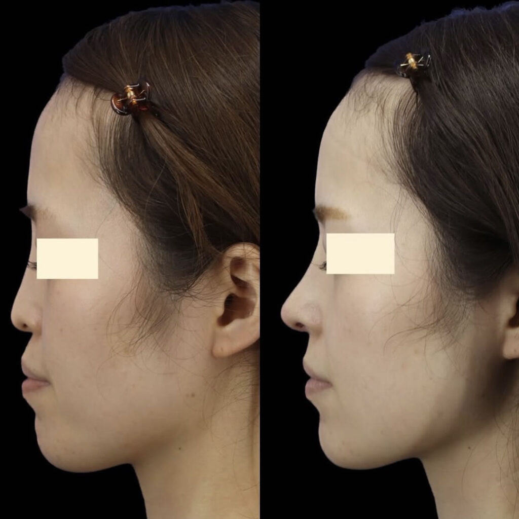 肋軟骨を使用した鼻フル整形と鼻唇角形成の症例写真