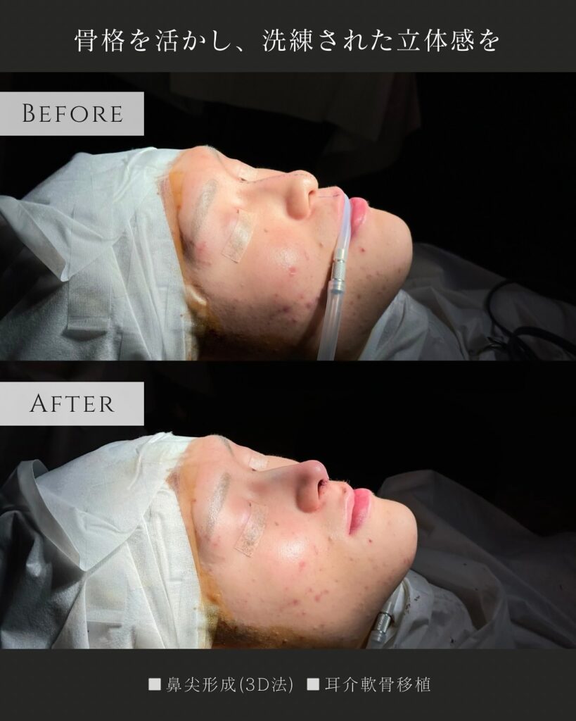 鼻尖形成と耳介軟骨移植の症例写真 (10)