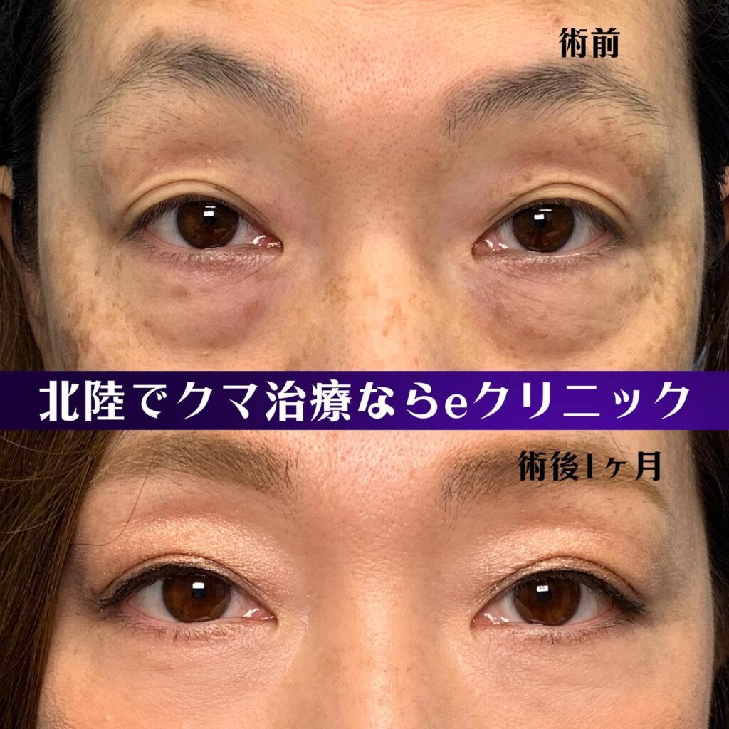 目の下のクマ取りの症例写真