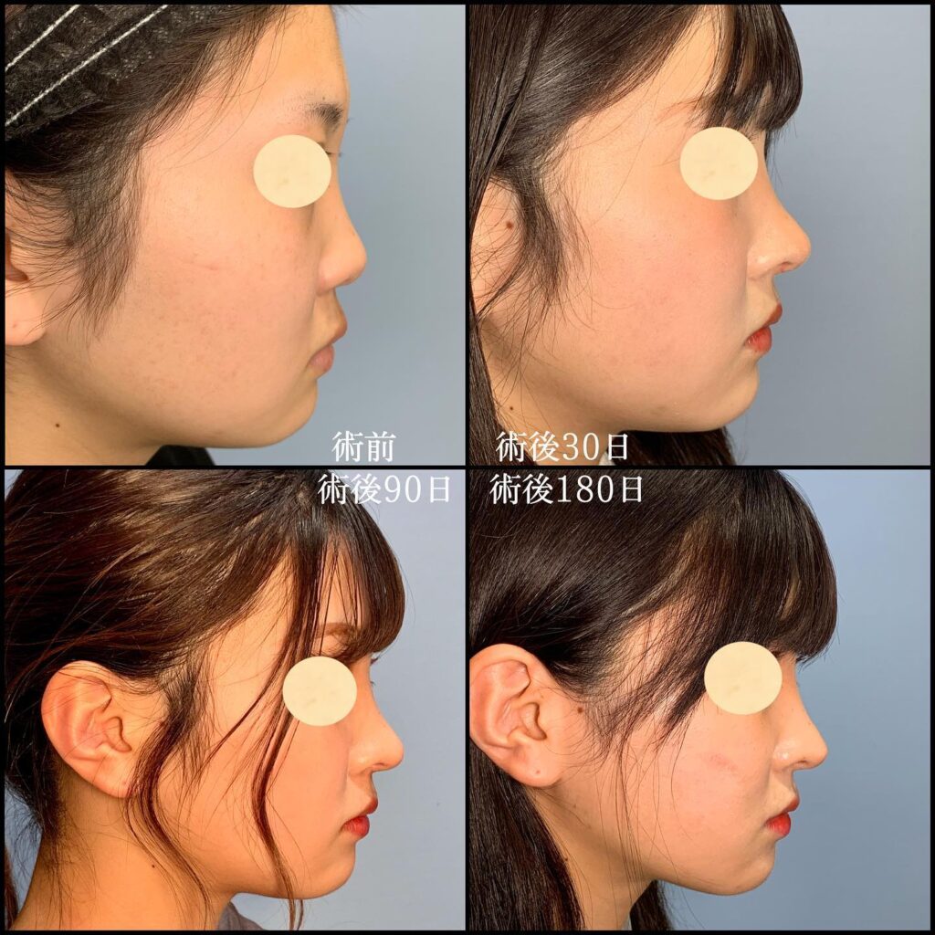 鼻中隔延長の症例写真 (2)