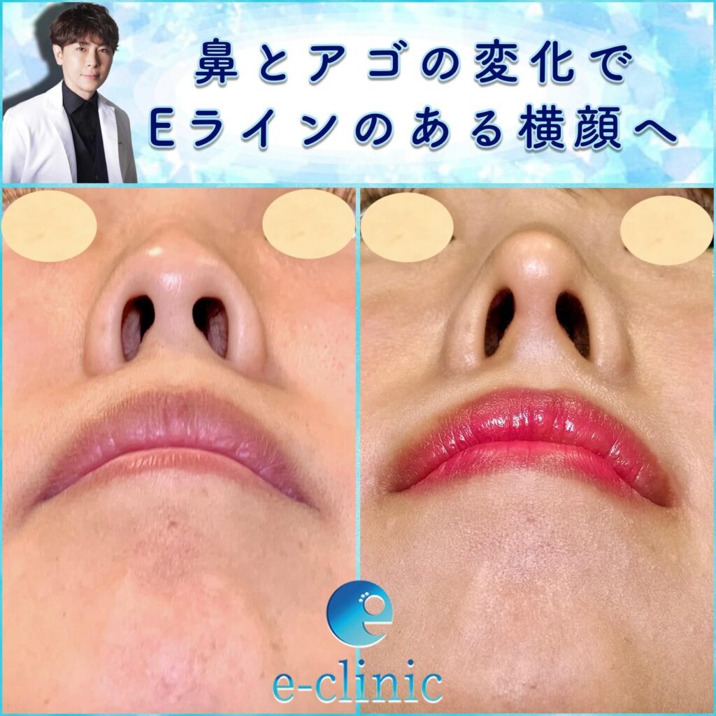 鼻尖形成と軟骨移植と鼻中隔延長と口角挙上と顎のヒアルロン酸の症例 (3)