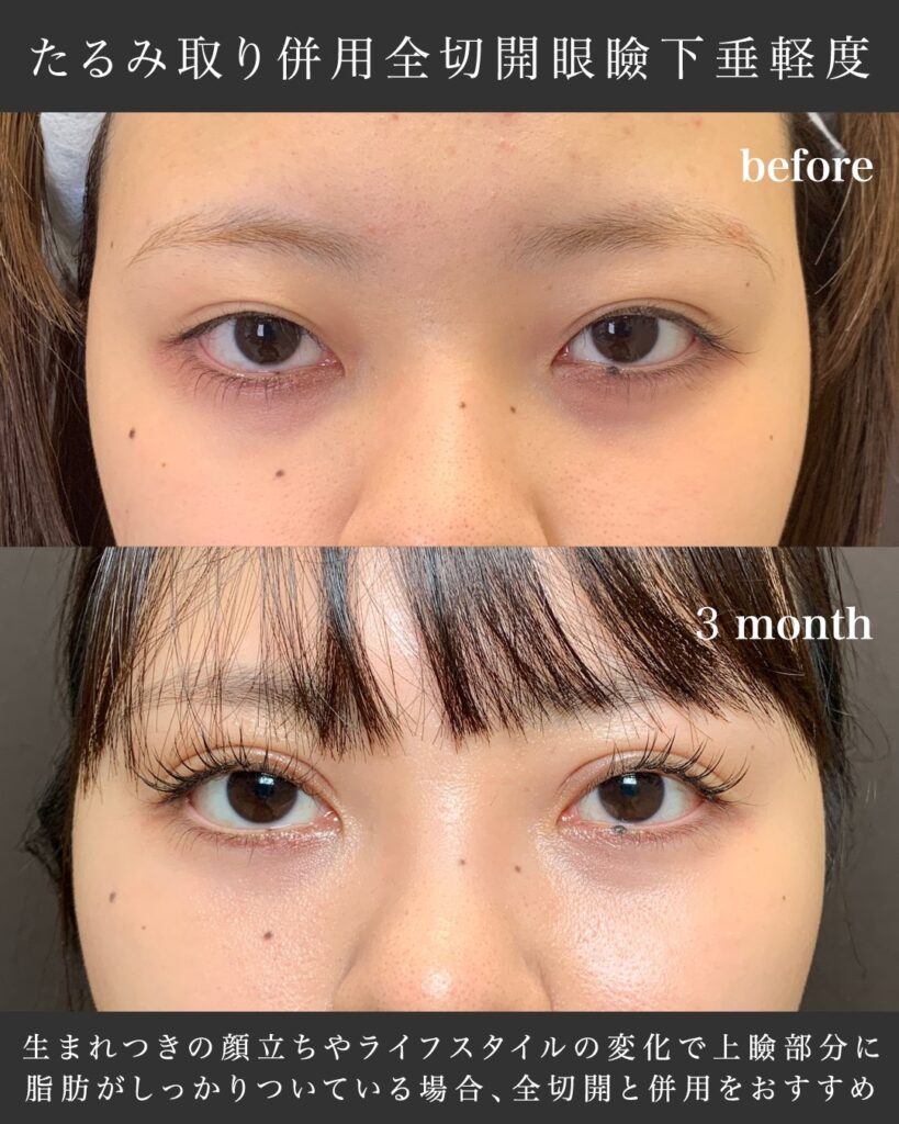 たるみ取り併用全切開と眼瞼下垂の症例写真