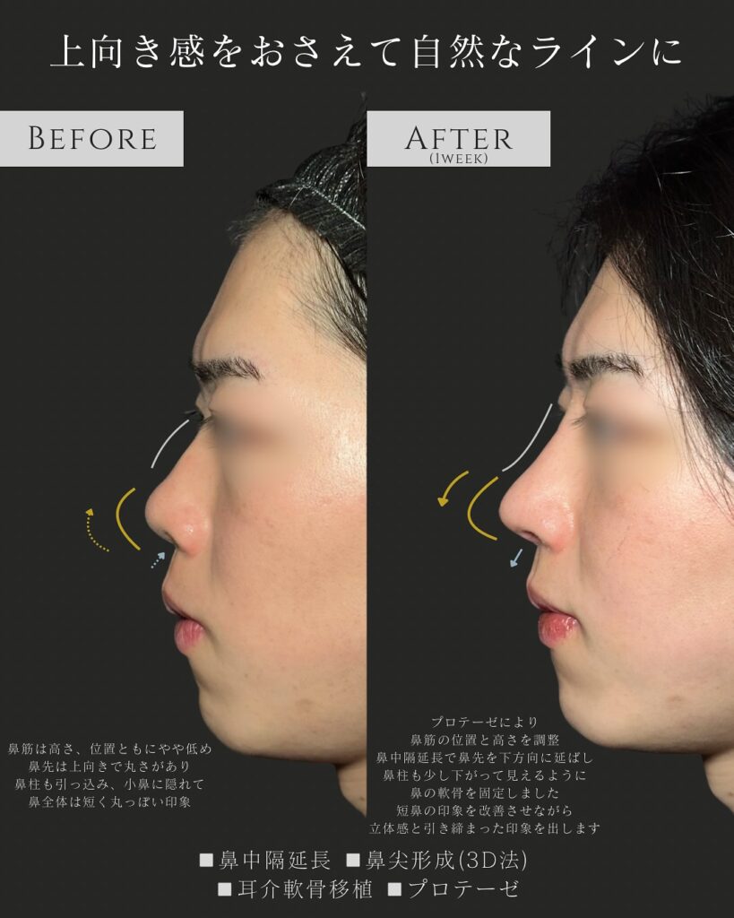 鼻中隔延長と鼻尖形成と耳介軟骨移植とプロテーゼの症例写真 (1)