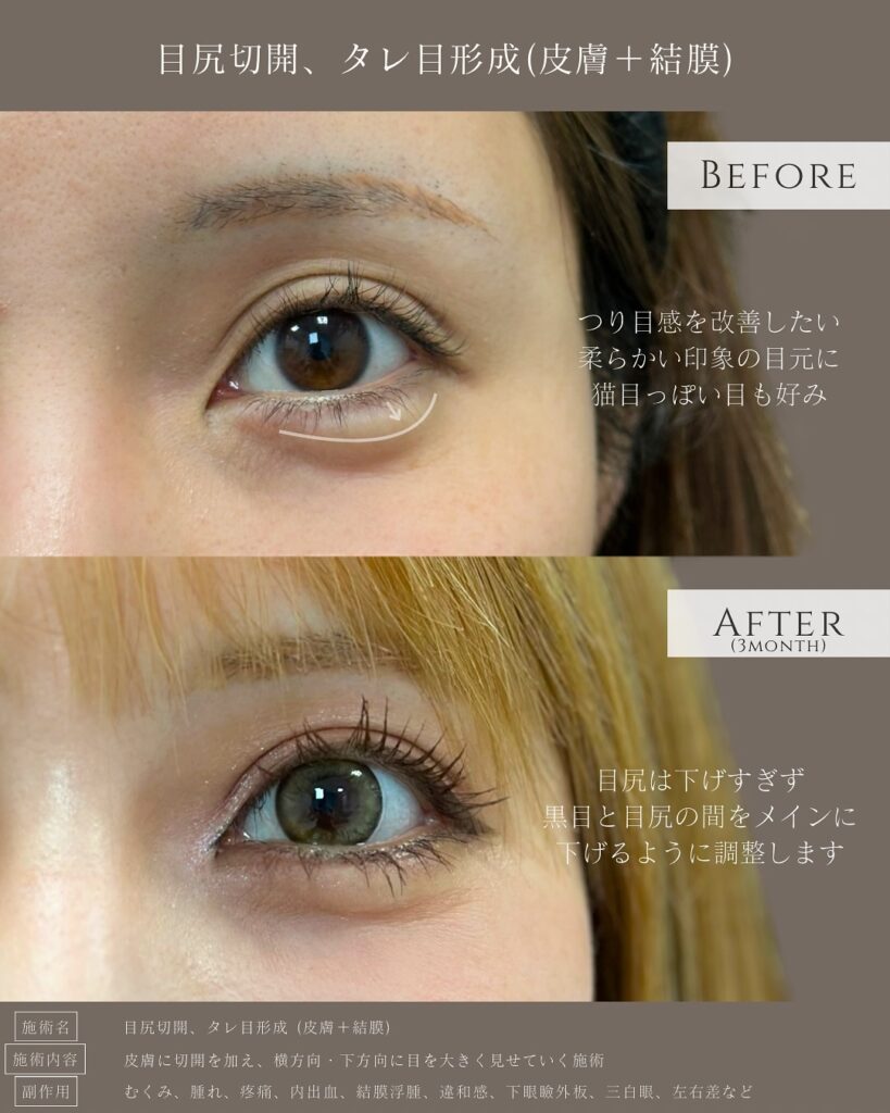 目尻切開とタレ目形成の症例写真 (34)