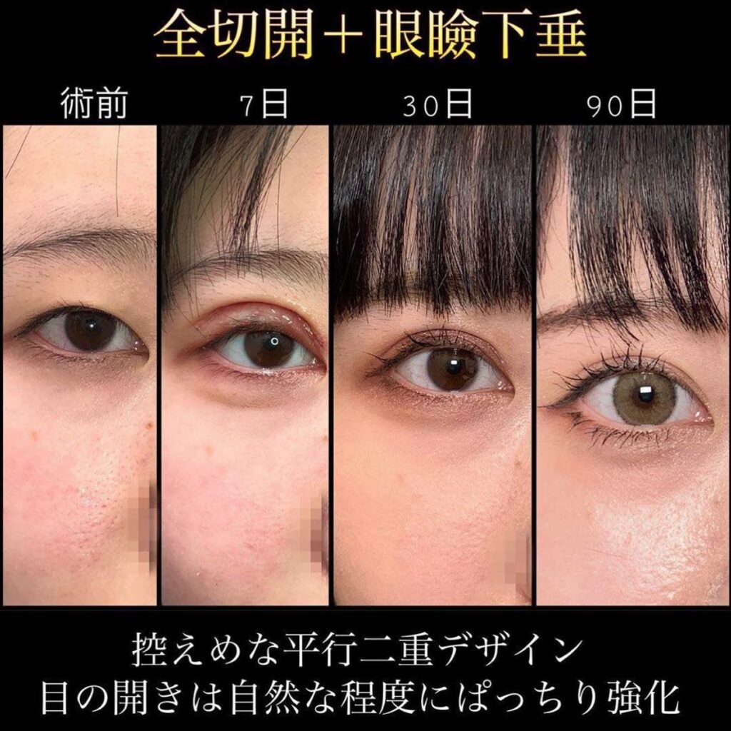 全切開と眼瞼下垂の症例写真