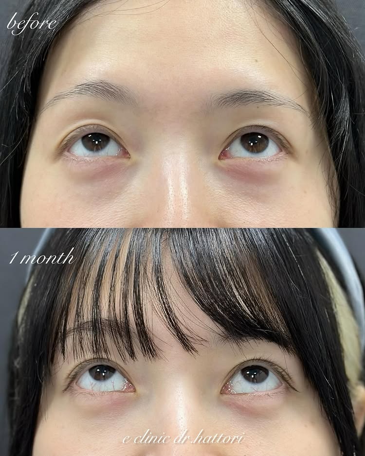 裏ハムラ法の症例写真 (67)