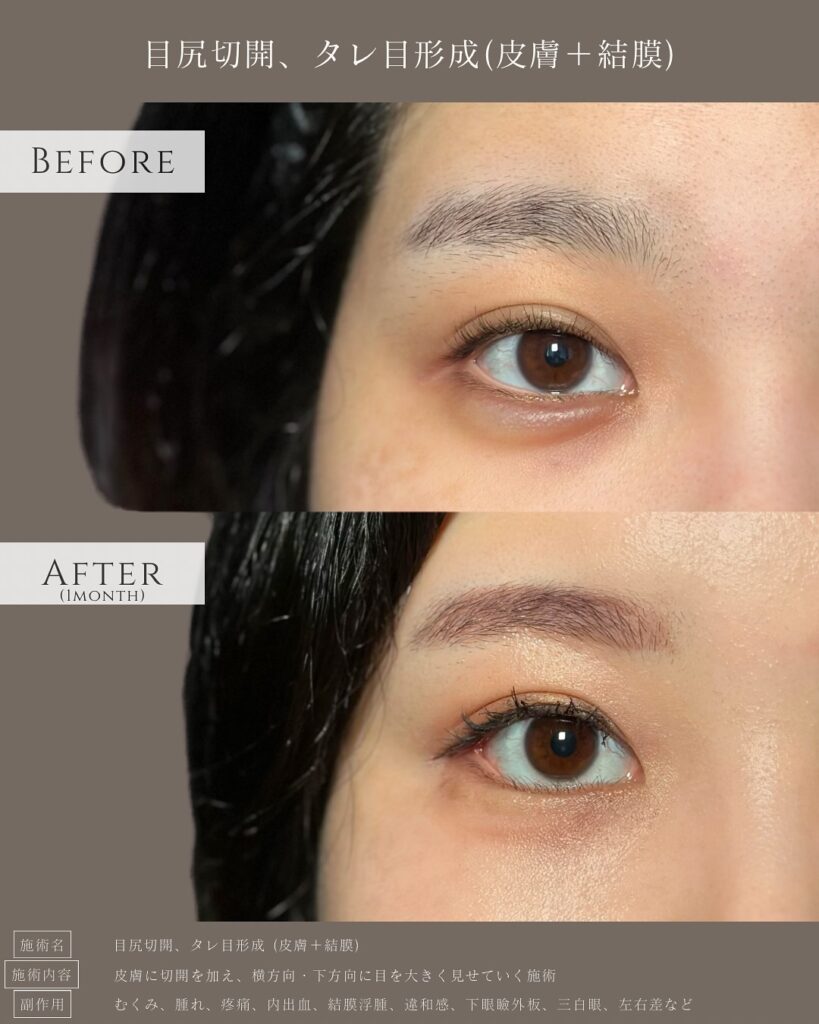 目尻切開とタレ目形成の症例写真 (37)