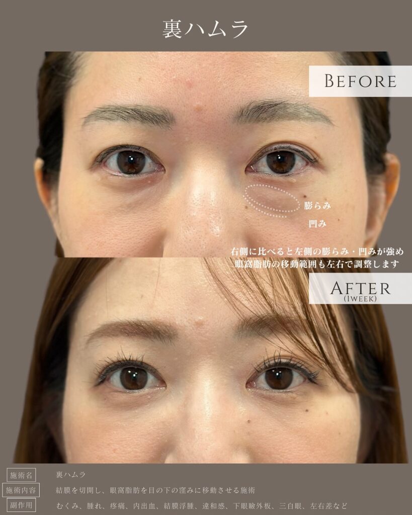 裏ハムラ法の症例写真 (16)