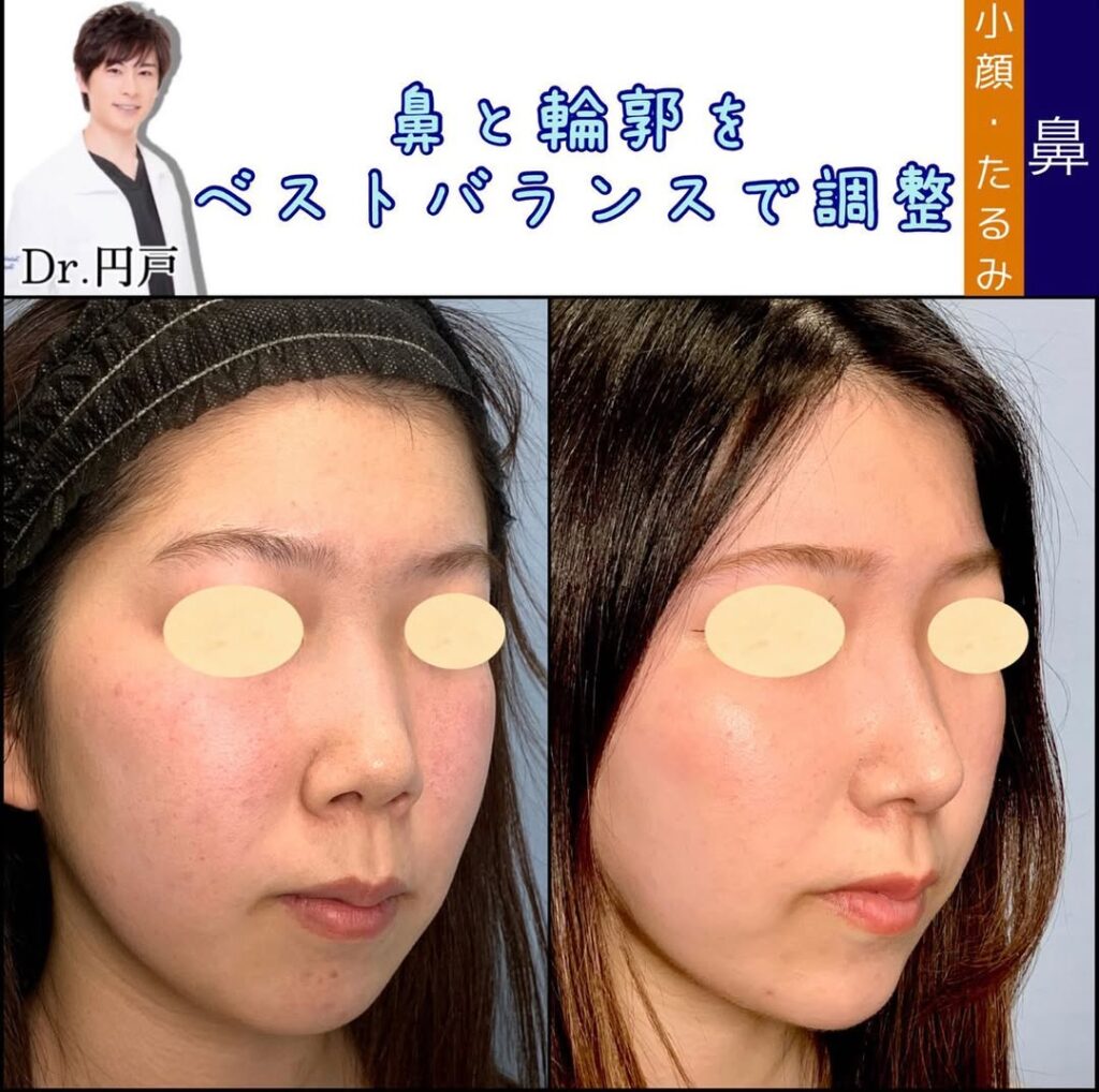 鼻中隔延長と鼻背部軟骨移植と鼻尖形成と軟骨移植と輪郭形成と顎のヒアルロン酸の症例写真 (3)