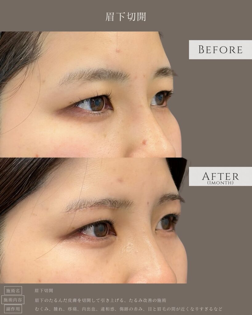眉下切開の症例写真 (1)