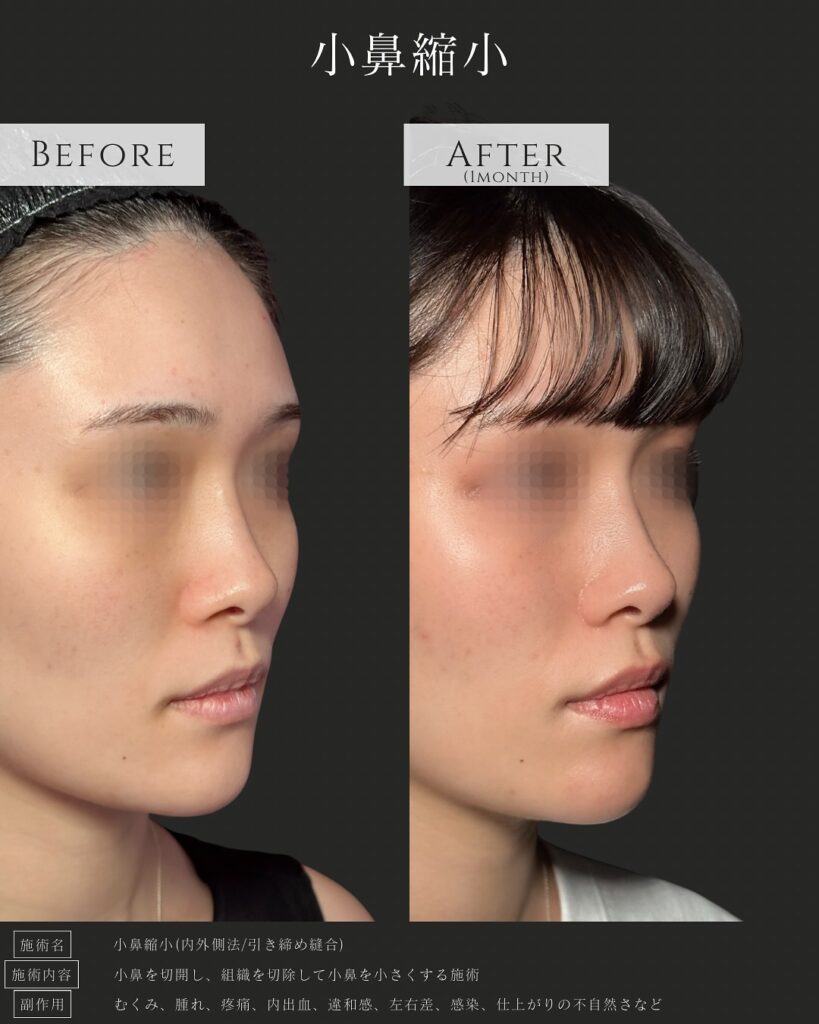 小鼻縮小の症例写真 (2)
