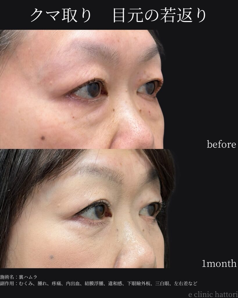 裏ハムラ法の症例写真 (51)