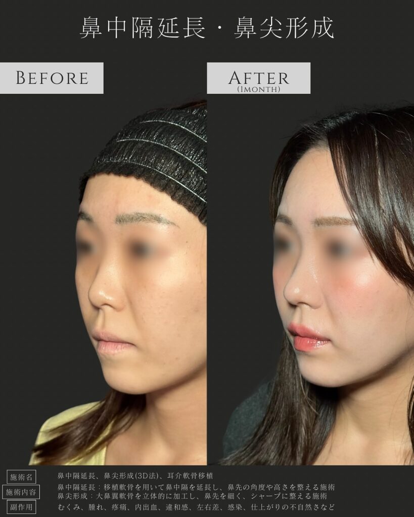 鼻中隔延長と鼻尖形成と耳介軟骨移植の症例写真 (5)