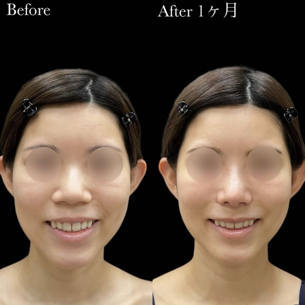 小鼻縮小の症例写真