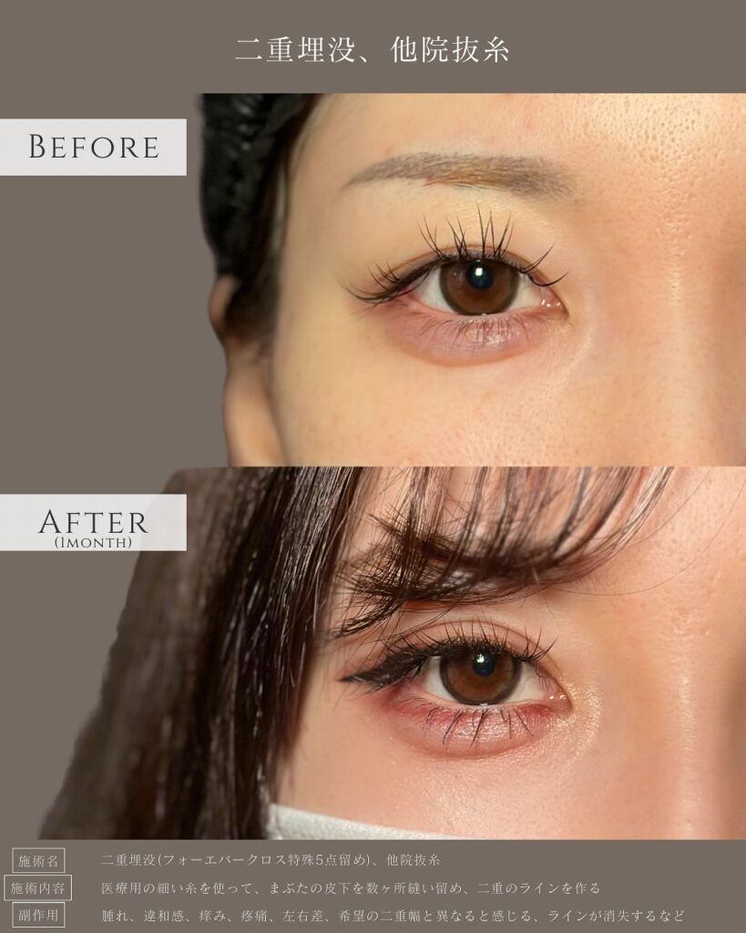 埋没法と他院抜糸の症例写真 (4)