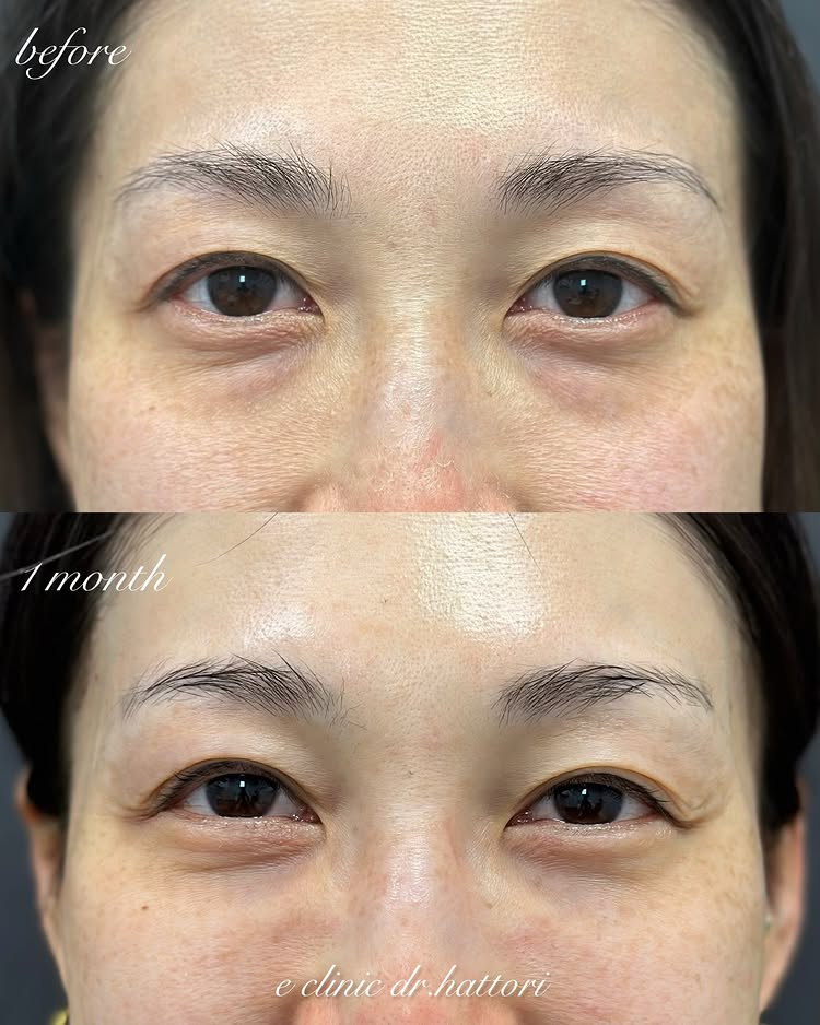 裏ハムラ法とナノリッチの症例写真 (24)