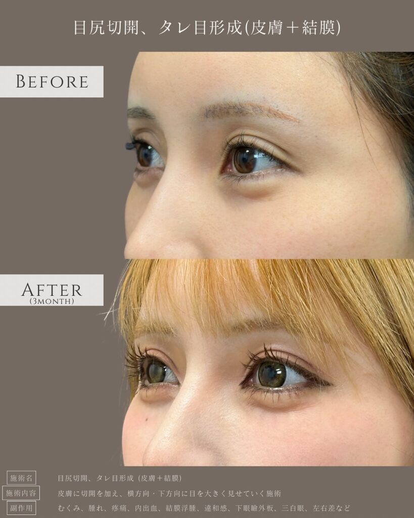 目尻切開とタレ目形成の症例写真 (32)