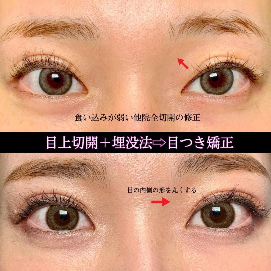 目上切開と埋没法の症例写真 (1)