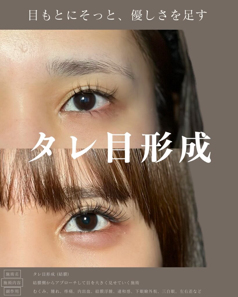 タレ目形成の症例写真 (15)