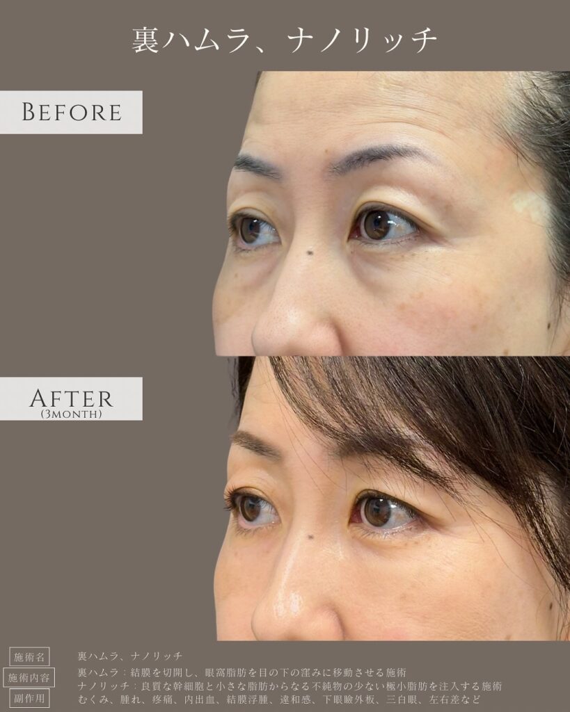 裏ハムラ法とナノリッチの症例写真 (3)