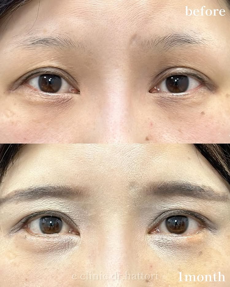 タレ目形成の症例写真 (30)