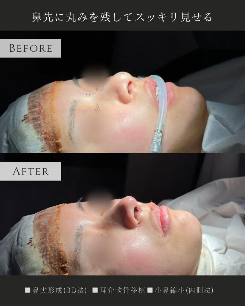 鼻尖形成と耳介軟骨移植と小鼻縮小の症例写真 (11)